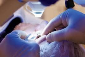 eye surgery